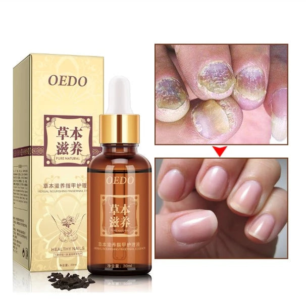 Herbal Fungal Nail Treatment Essential oil Hand and Foot Whitening Toe Nail Fungus Removal Infection Feet Care Polish Nail Gel