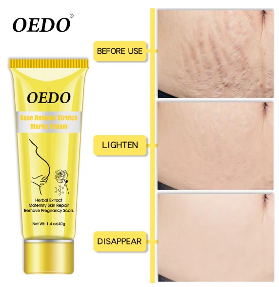 Rose Remove Stretch Marks Cream Anti Wrinkle Anti Aging Maternity Skin Repair Remove Pregnancy Scars Treatment Body Skin Care